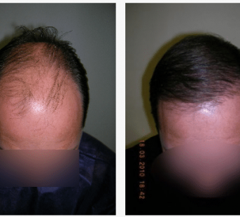 caso real microinjerto de pelo imagen de caso real microinjerto de pelo