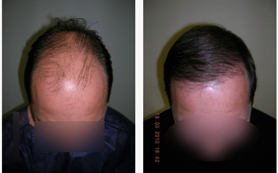 caso real microinjerto de pelo imagen de caso real microinjerto de pelo
