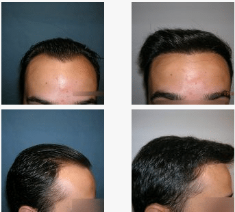 imagen de caso real microinjerto de pelo 2
