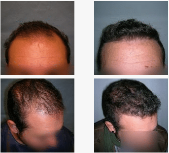 imagen de caso real microinjerto de pelo 8