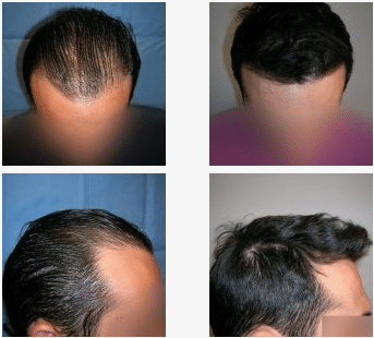 imagen de caso real microinjerto de pelo 7