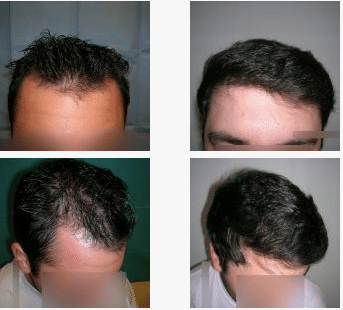 imagen de caso real microinjerto de pelo 6