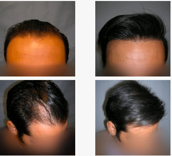 imagen de caso real microinjerto de pelo 5