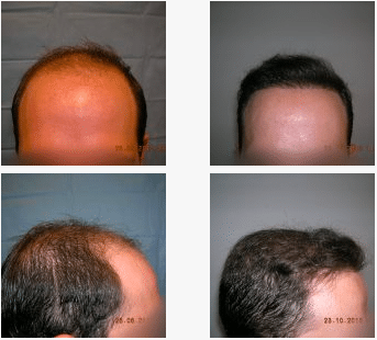 imagen de caso real microinjerto de pelo 4
