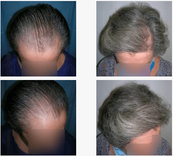 imagen de caso real microinjerto de pelo 3