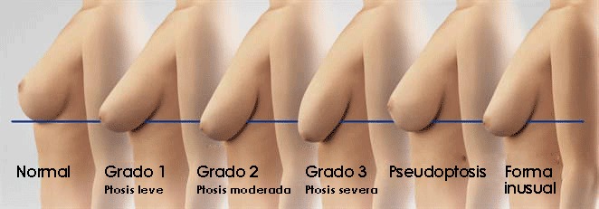imagen de Grados de Ptosis mamarias elevacion de senos