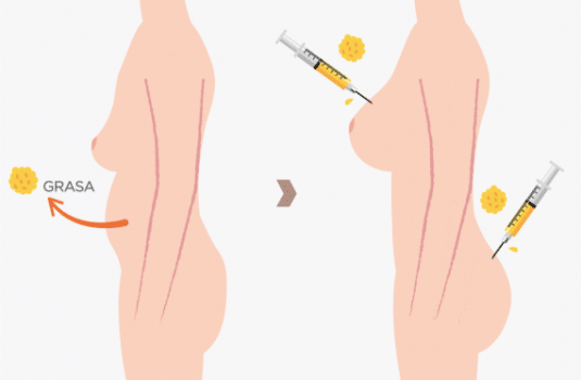 lipotransferencia y lipofilling madrid
