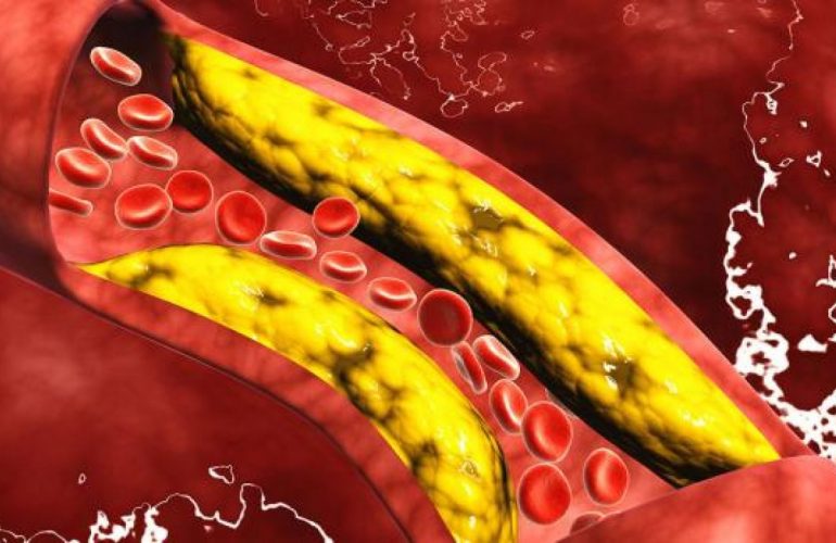 imagen de Enfermedad Cerebrovascular