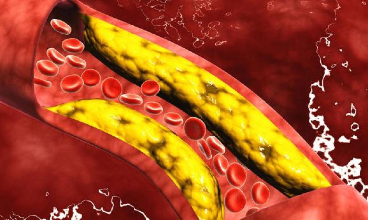 imagen de Enfermedad Cerebrovascular
