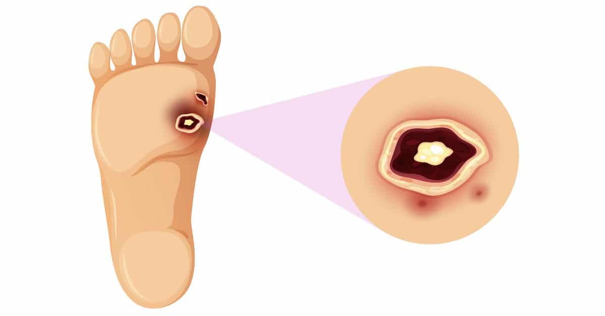 imagen de Pie Diabético clinica medivas