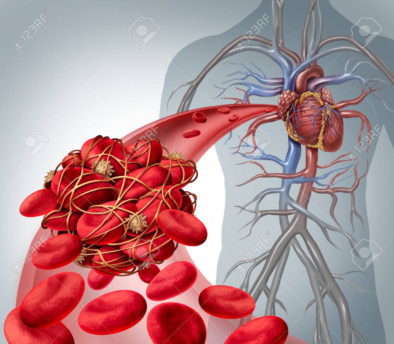IMAGEN DE Trombosis Venosa y Embolia Pulmonar