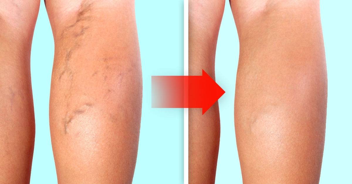 imagen de Varices tratamiento clinica medivas