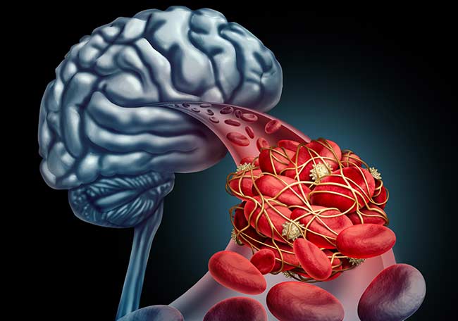 imagen accidente cerebrovascular isquémico enfermedad cerebrovascular