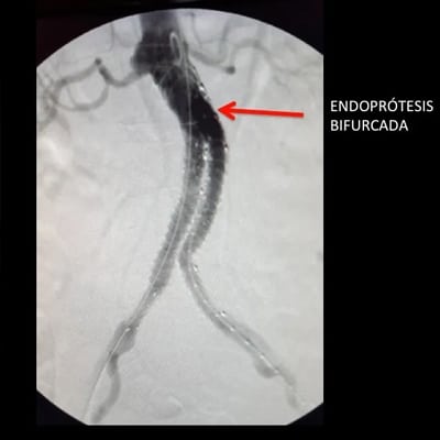 aneurisma de aorta 2