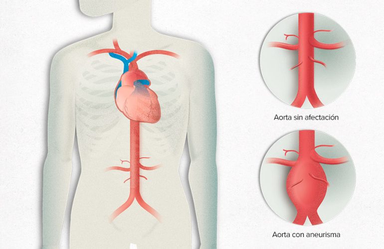 imagen de aneurisma de aorta clinica medivas