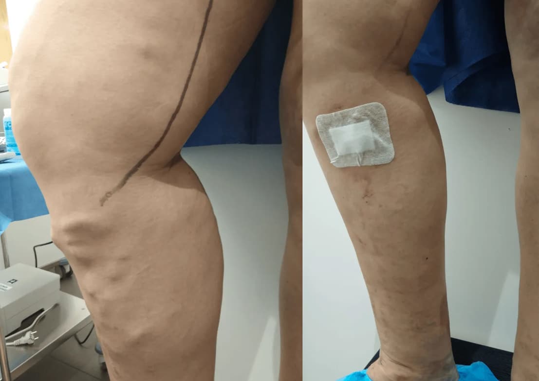 imagen de caso real de varices sin cirugia 1