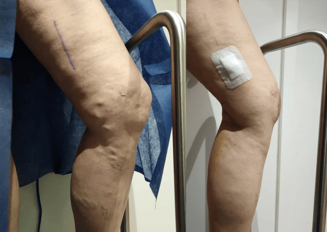 caso real de varices sin cirugia 2