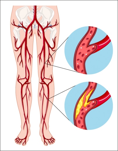 imagen de claudicacion intermitente clinica medivas