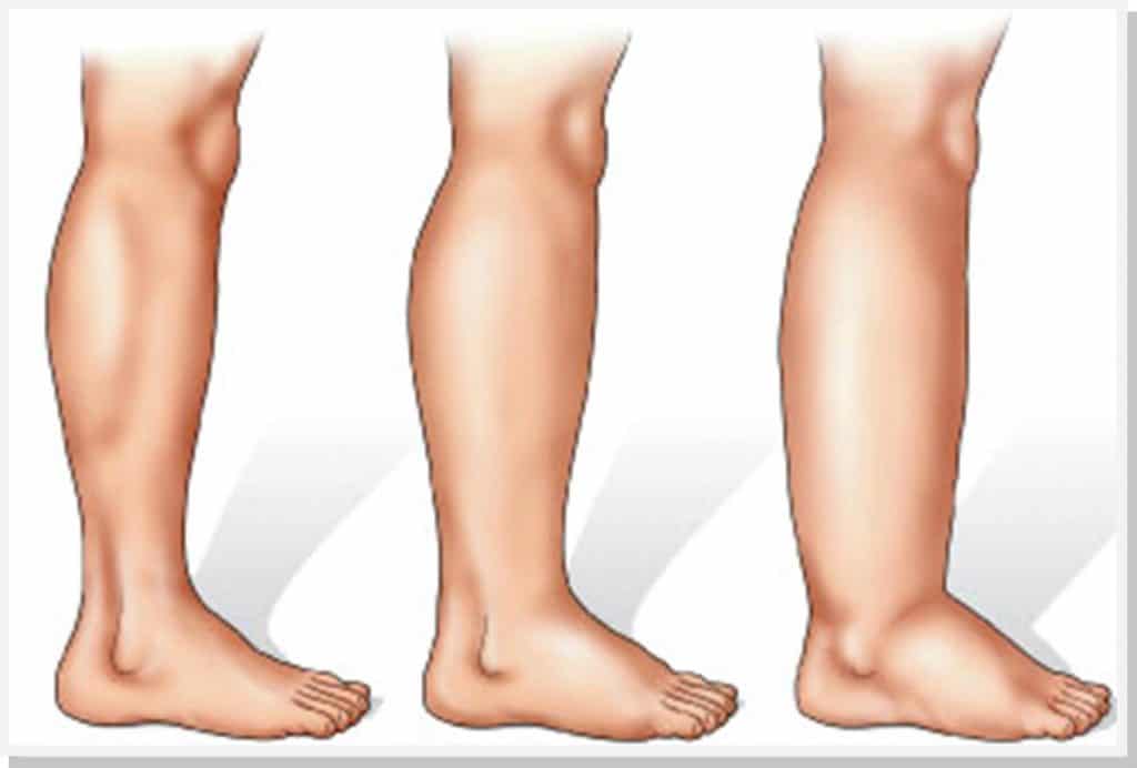 imagen de linfedema clinica medivas