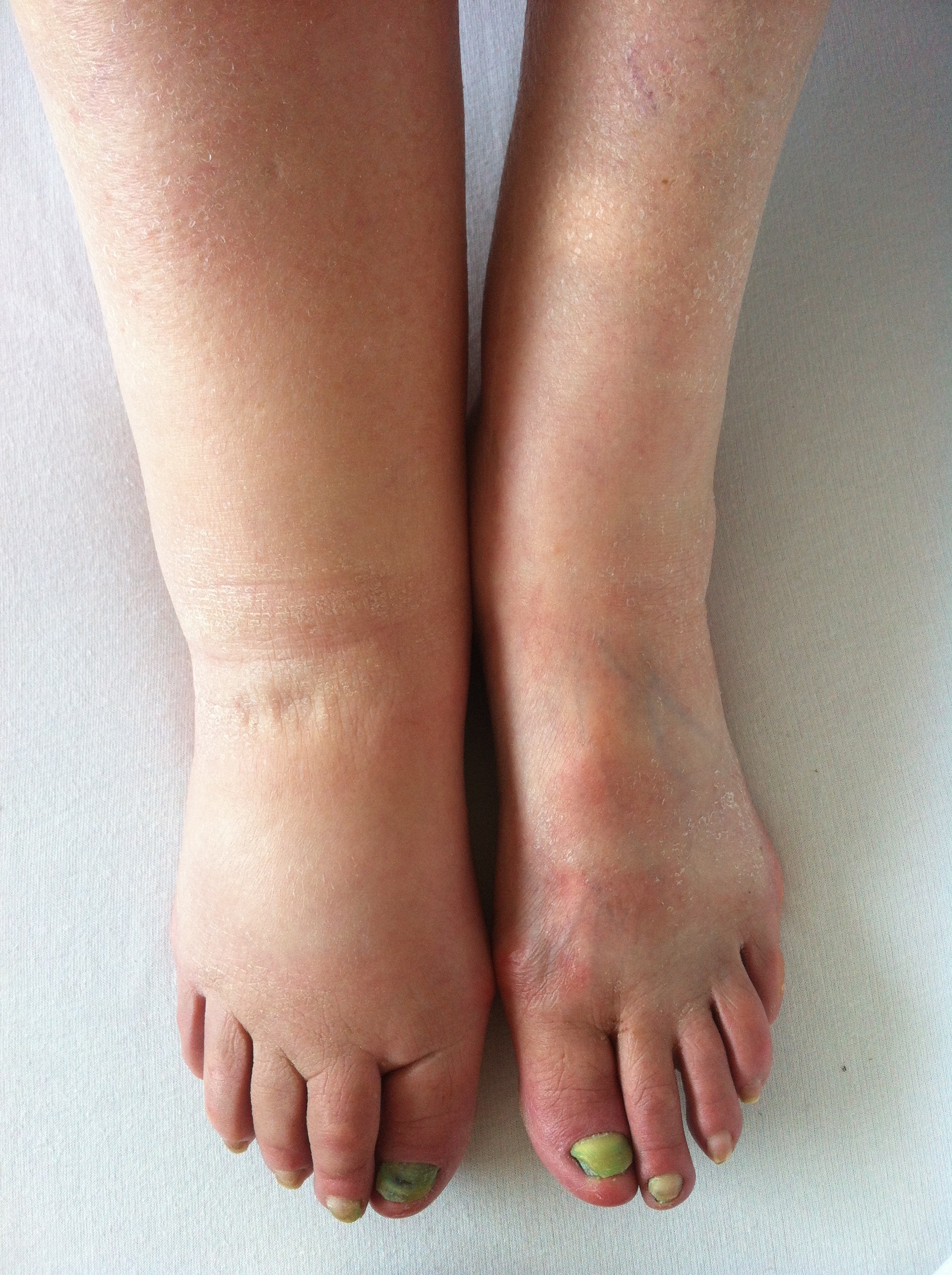 imagen de linfedema