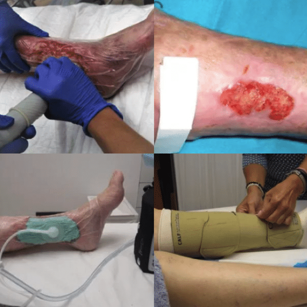 tratamiento de varices en Madrid