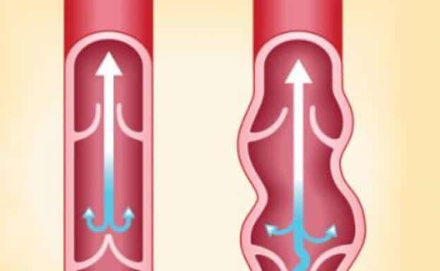 imagen de varices tratamiento y diagnostico medivas