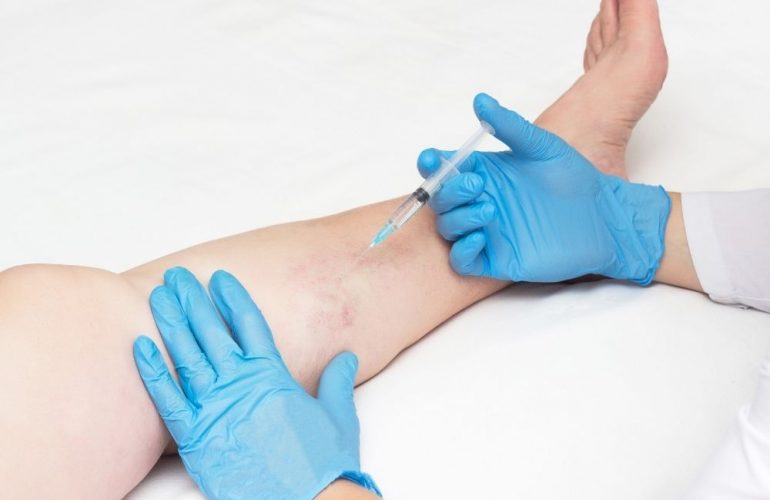 imagen de Tratamiento de varices clinica medivas madrid y valladolid