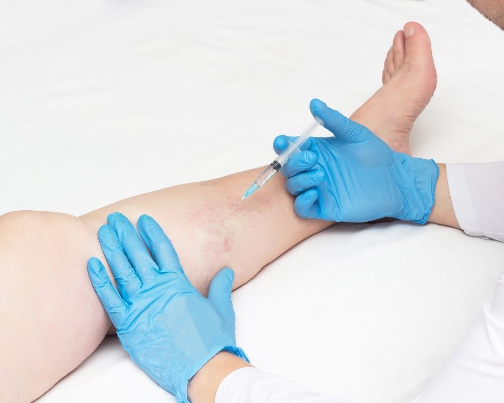 imagen de Tratamiento de varices clinica medivas madrid y valladolid