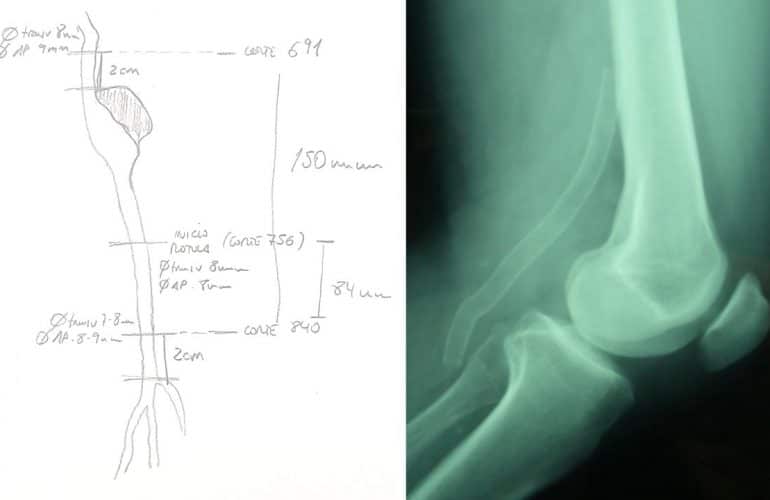 imagen de medición en el tratamiento endovascular de los aneurismas poplíteos