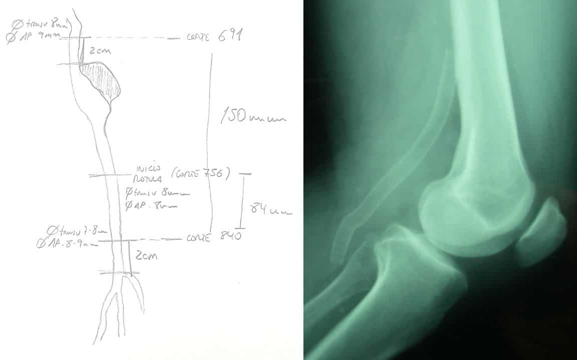 imagen de medición en el tratamiento endovascular de los aneurismas poplíteos