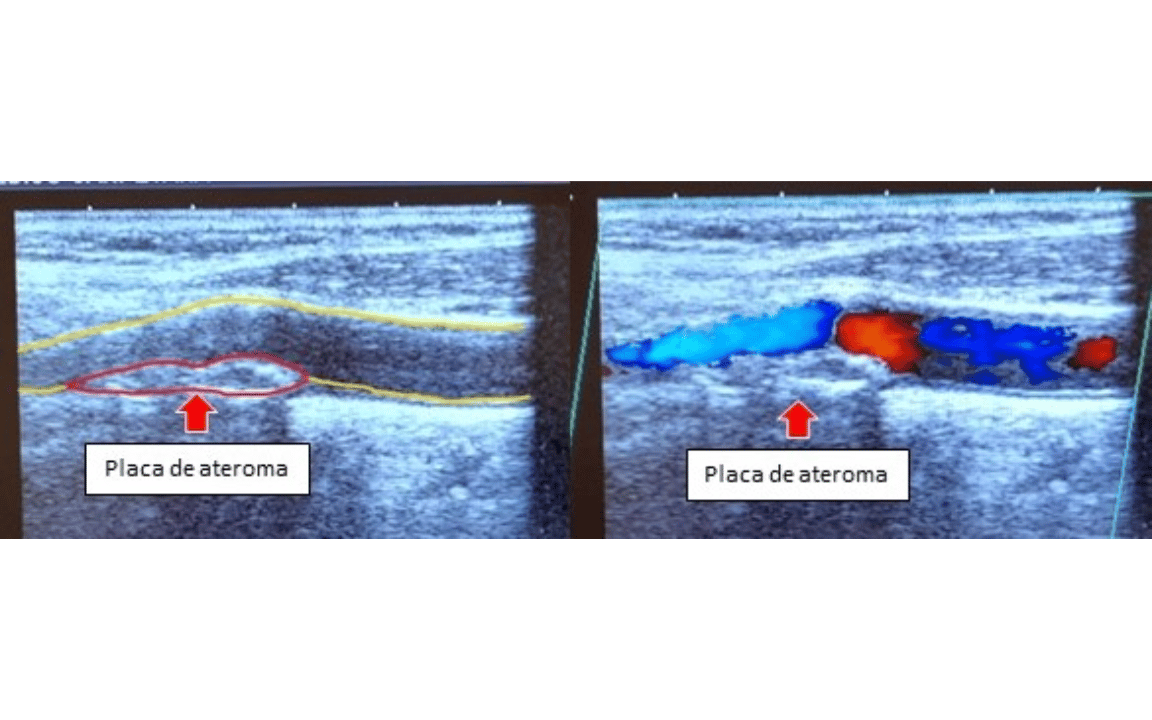 Estenosis carotídea: un riesgo que no avisa.