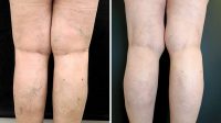 presoescleroterapia