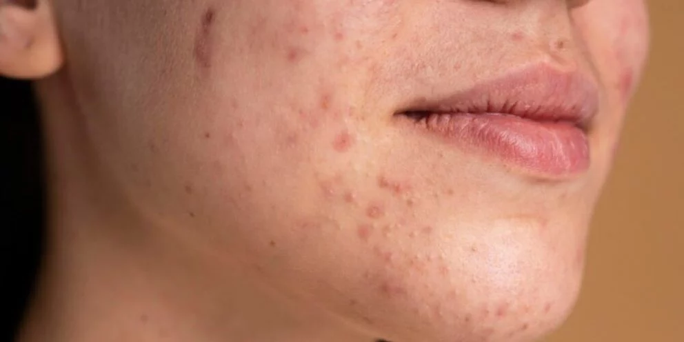 Tratamientos, cuidados y consejos para prevenir las manchas en la piel