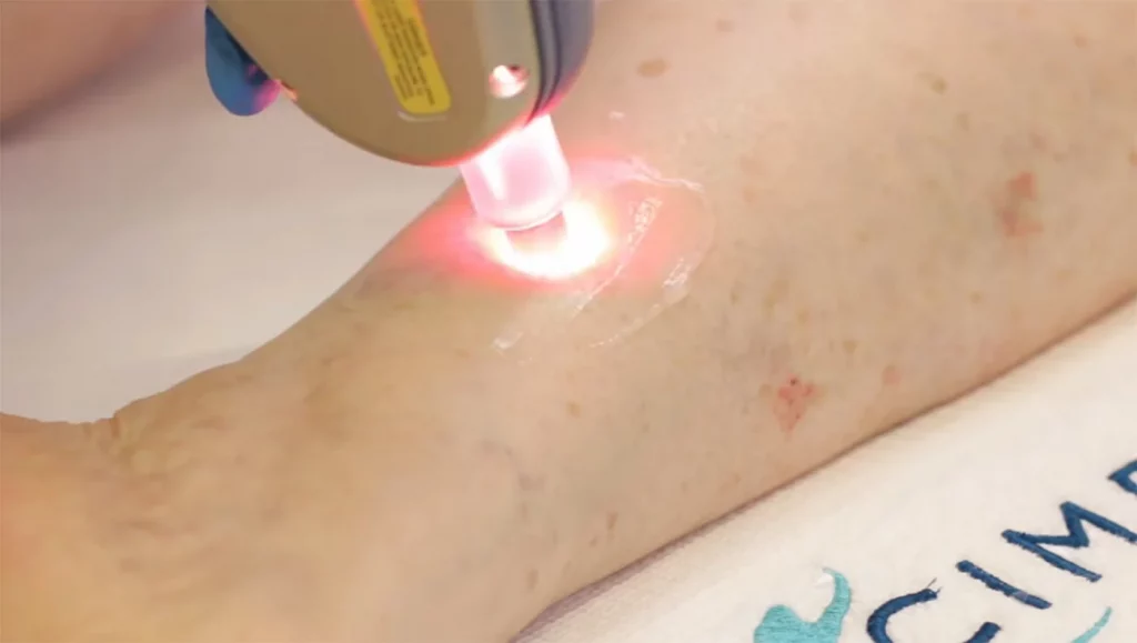 ¿Cómo la tecnología láser ha cambiado el tratamiento de las varices? | Clínica Medivás Madrid varices vasculight
